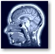 Side view of a CAT scan of a brain