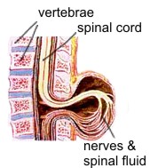 diagram of the protruding sac of spinal fluid and tissue in the vertebrae of an individual with spina bifida